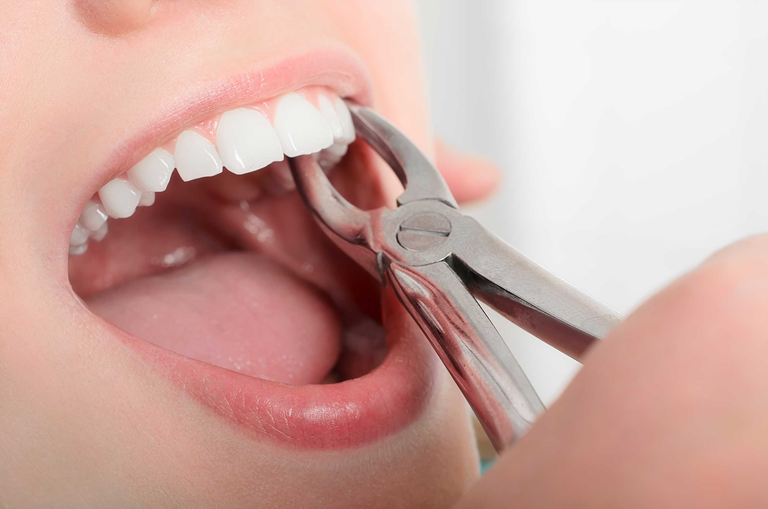 Tooth Extraction treatment image