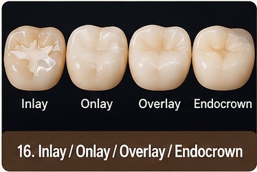 Inlay, Onlay & Overlay treatment image