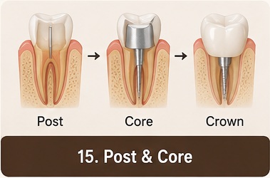 Post & Core treatment image