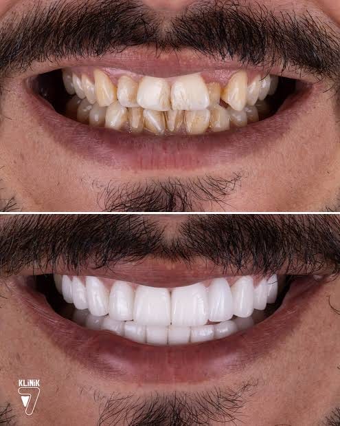Smile Design treatment image