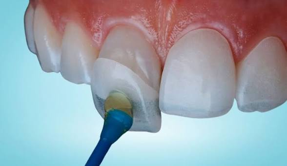 Veneers treatment image