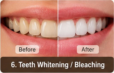 Teeth Whitening / Bleaching treatment image