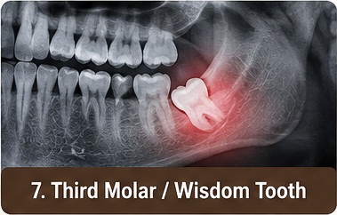 Wisdom Tooth (Third Molar) treatment image